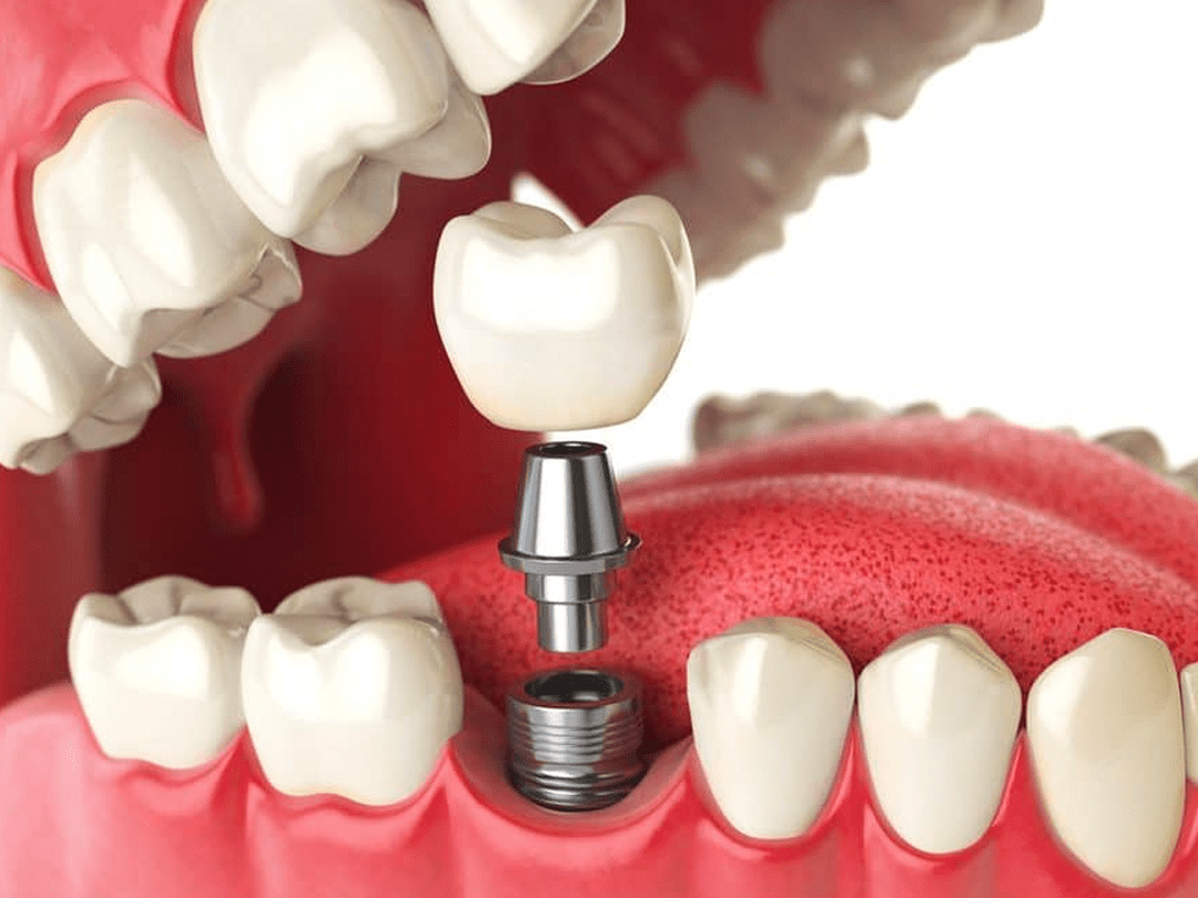 010-implantes-dentarios