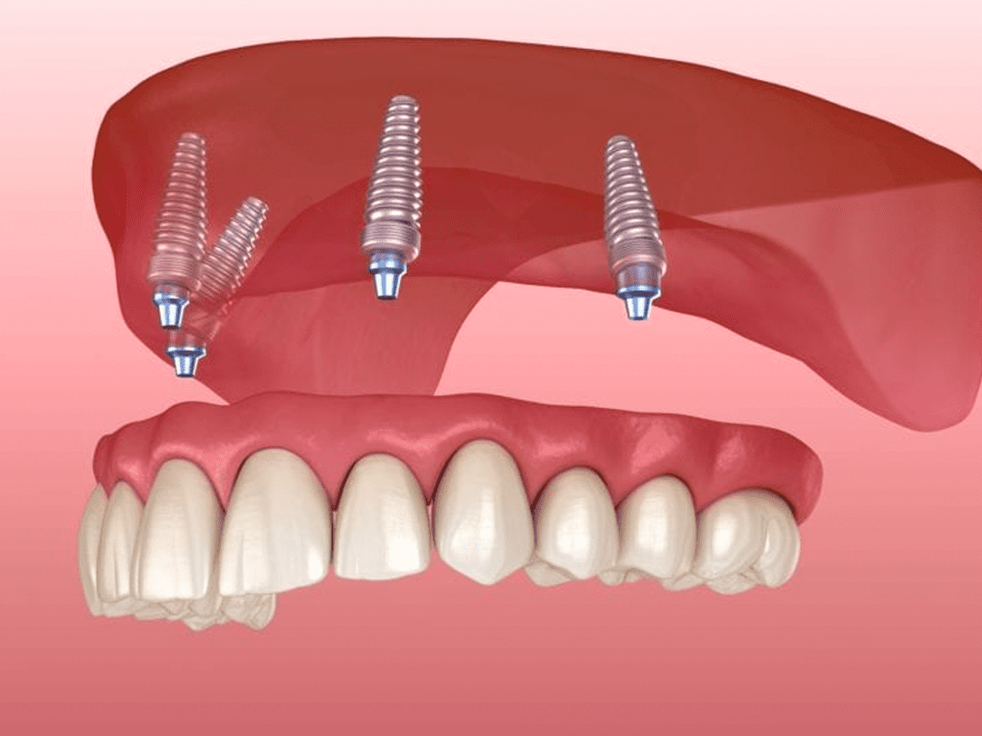 011-proteses-dentarias